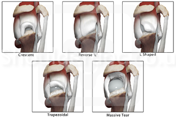 Types of shop rotator cuff tears